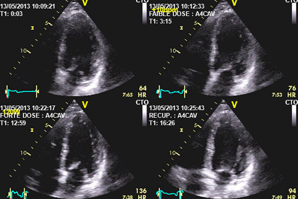 Échographe cardiologie